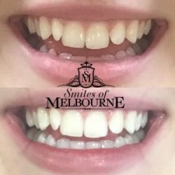 Teeth Whitening Melbourne Dentist – Smiles of Melbourne