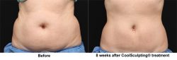 Coolsculpting in San Jose CA | Mendhair.com