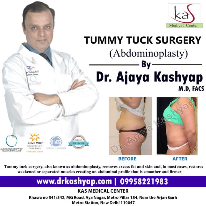 Best Tummy Tuck Surgery Cost in Delhi India – KAS Medical Center