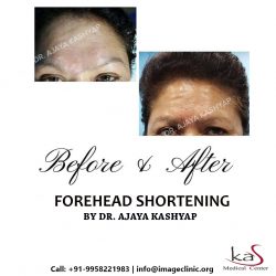 Book an Appointment for Forehead Reduction Surgery in Delhi