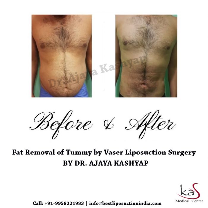 Fat Removal of Tummy by Vaser Liposuction Surgery | Dr Kashyap, Delhi, India