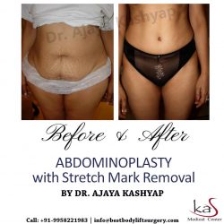 Book an Appointment for Tummy Tuck Surgery with Stretch Marks Removal in Aya Nagar, Delhi