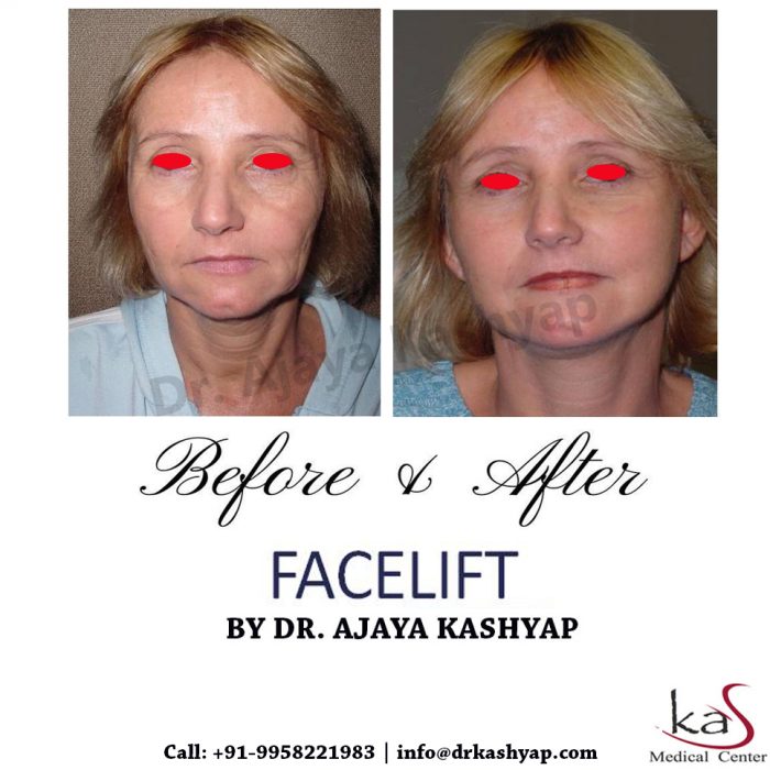 Consult the Best Face Lift Surgeon Clinic in Delhi