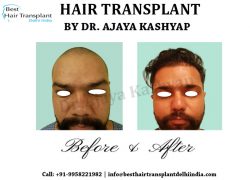 Best Hair Transplant Clinic in Delhi: KAS Medical Center