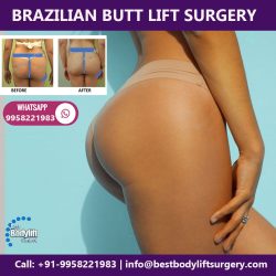 Brazilian Butt Lift Surgery by Dr. Ajaya Kashyap Plastic Surgeon in Delhi, India