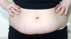 Abdominoplasty with Stretch Mark Removal Surgery in Delhi