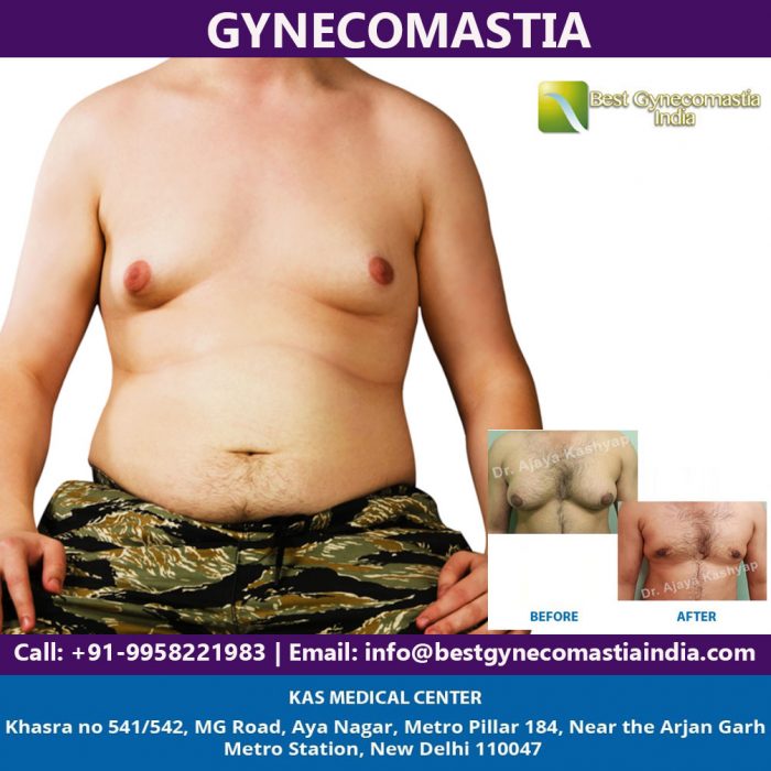 Best Male Breast Reduction Surgeon India