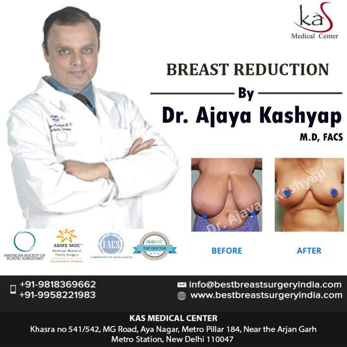 Breast Reduction Surgery at Best Cost in Delhi India