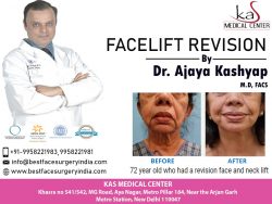 Best Face Surgery Clinic in Delhi Call 919958221981