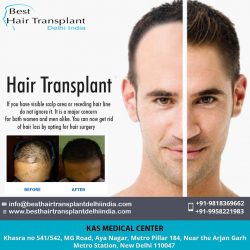 Best Hair Transplant Clinic in Delhi