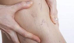 Veins Treatments Near Me