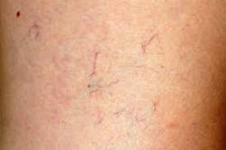 Spider Veins Treatments Near Me