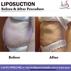 Best Liposuction Surgeon Clinic in New Delhi