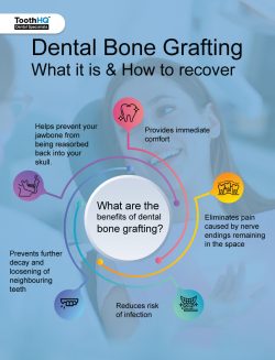What Are The Benefits Of Dental Bone Grafting?