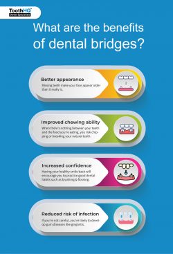How Does A Dental Bridge Treatment Work?