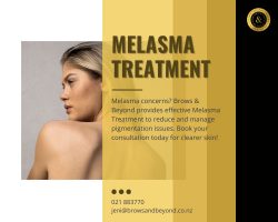 Melasma Treatment: Restore Your Skin’s Natural Beauty