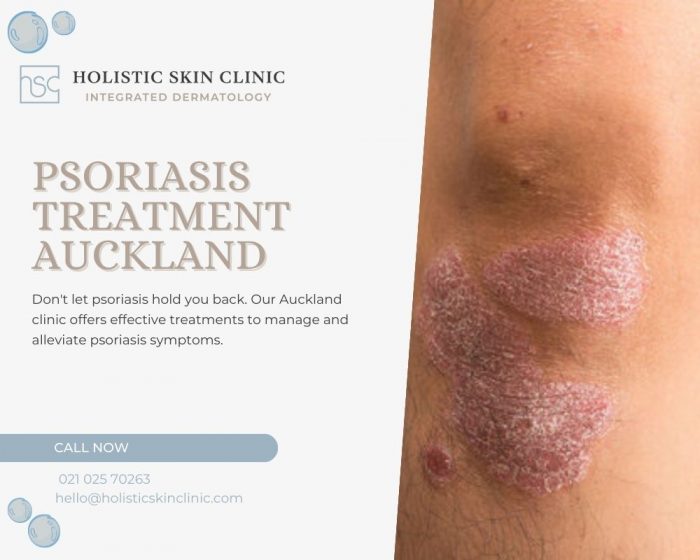 Effective Psoriasis Treatment in Auckland