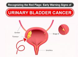 Early Warning Signs of Urinary Bladder Cancer – Mukat Hospital