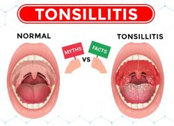 Tonsillitis Myths vs. Facts | Expert ENT Care at Mukat Hospital