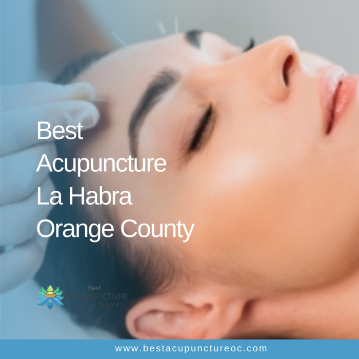 Best Acupuncture La Habra Orange County