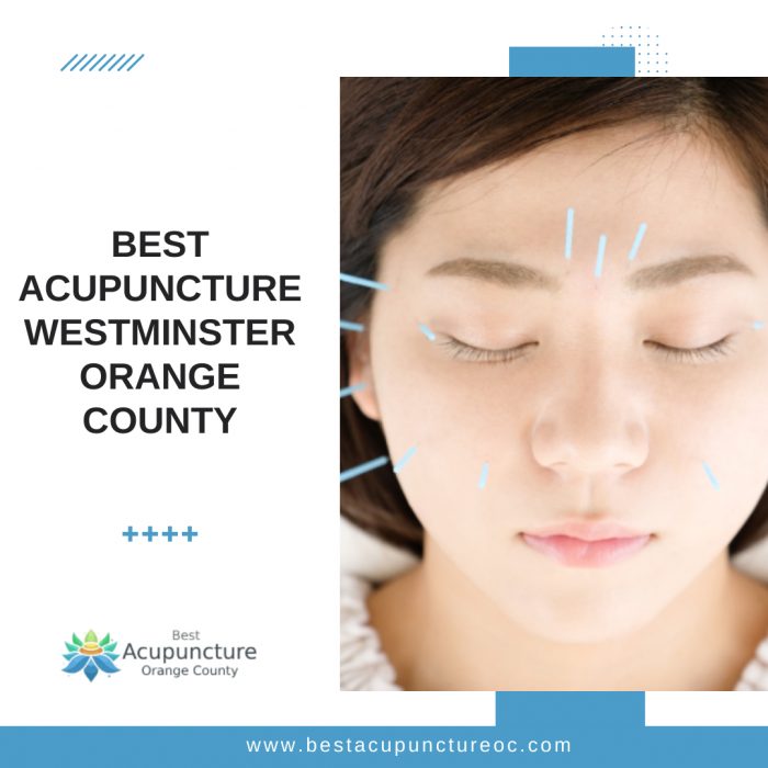 Best Acupuncture Westminster Orange County