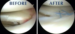 Exceptional Care for Torn Meniscus Repair