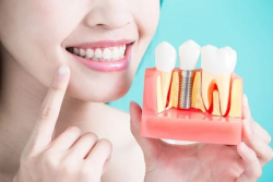 Comfortable Dental Implants and Dentures for a Complete Smile Makeover