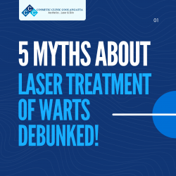 5 Myths About Laser Treatment of Warts – Debunked!