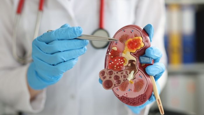 Kidney Stones Removal At Amcare Hospital