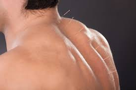 Acupuncture for Pain Management: A Holistic Approach to Lasting Relief