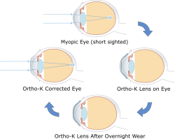 Orthokeratology in Melbourne & Greater Geelong