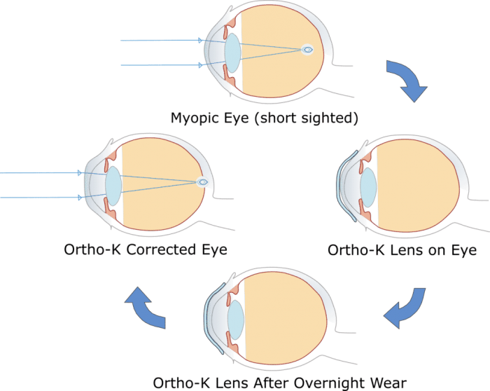 Orthokeratology in Melbourne & Greater Geelong
