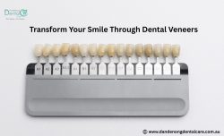 Transform Your Smile Through Dental Veneers