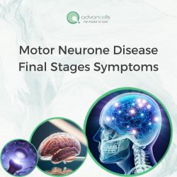 Illustration of Motor Neurone Disease (MND) Progression