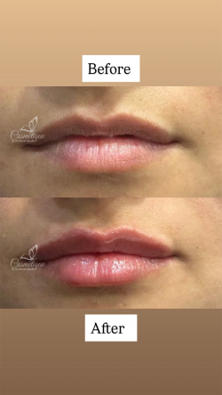 Best Lip Filler Treatment in Amritsar | Dr Simrat Sandhu