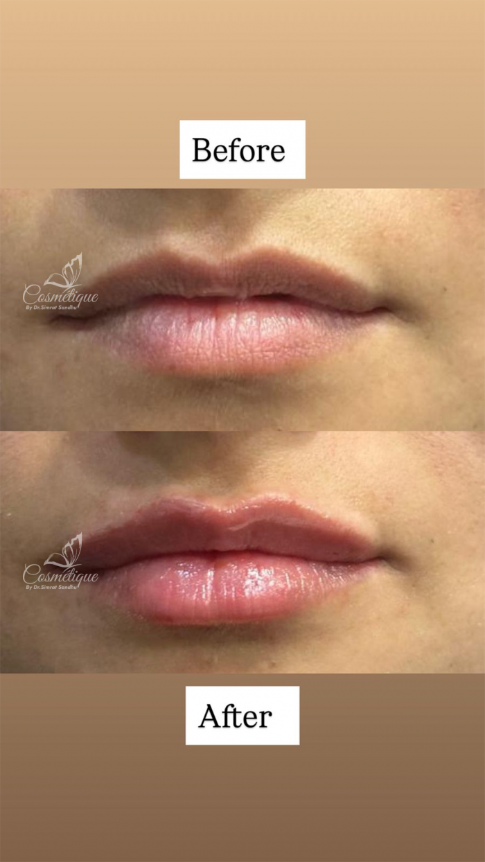 Best Lip Filler Treatment in Amritsar | Dr Simrat Sandhu