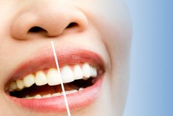 How Long Does Teeth Whitening Last