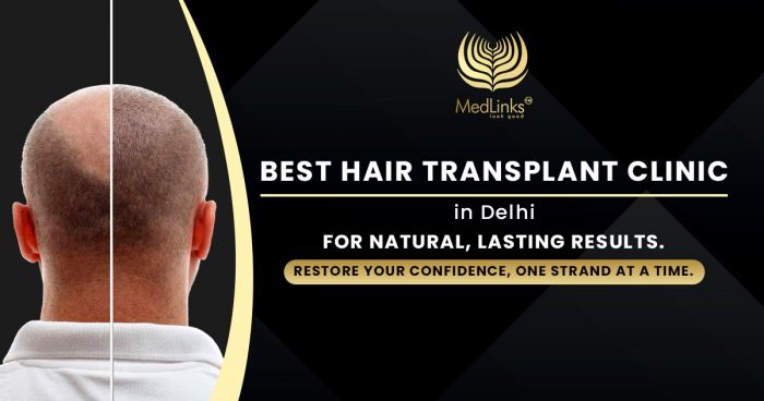 MedLinks Delhi – Best Hair Transplant Clinic for Hair Restoration