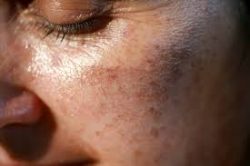 Book Dermamelan Peel in Sydney for Advanced Pigmentation Correction