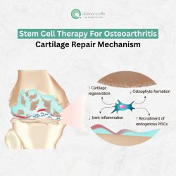 Stem Cell Therapy for Osteoarthritis- Cartilage Repair Mechanism