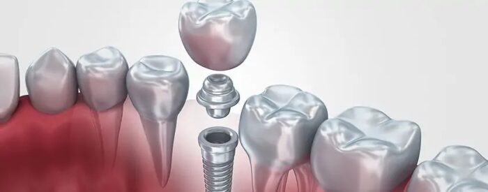 Why Choosing the Best Implant Dentist in Abu Dhabi Matters for Long-Term Oral Health