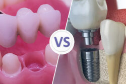 Tooth Implant vs Dental Bridge?