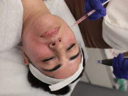 Dermapen 4 Treatment in Gurgaon | MedLinks