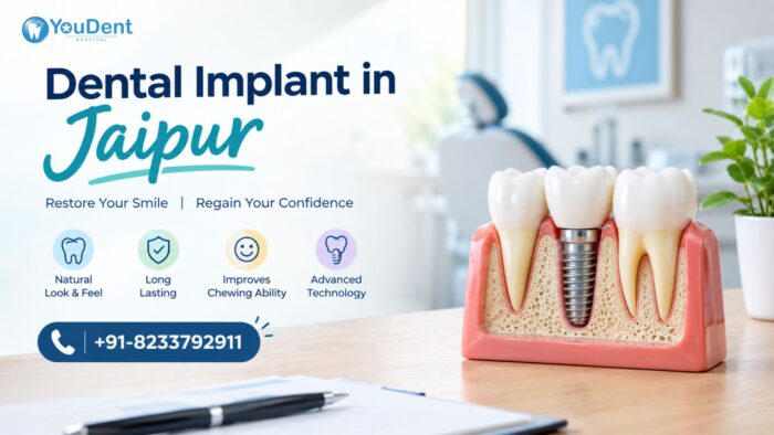 Dental Implant in Jaipur | Youdent – A Complete Smile Makes Life Better
