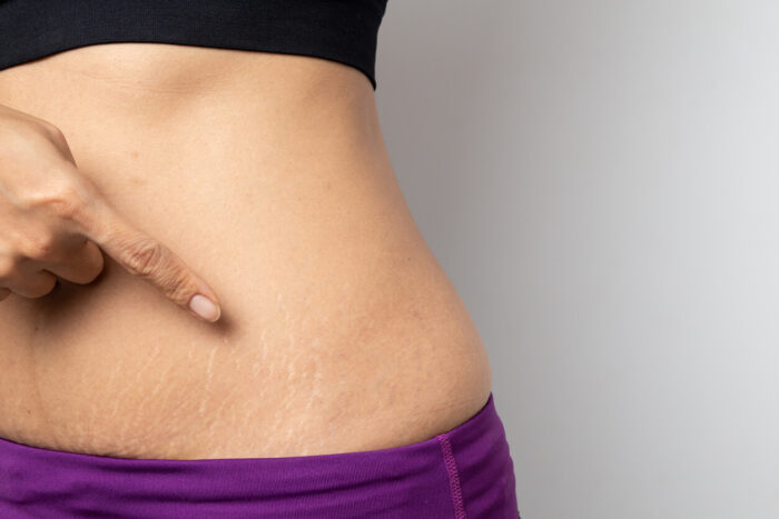 Easily Fade Away Stretch Marks With Skin Needling