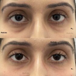 Under Eye Filler Treatment at MedLinks for Under Eye Rejuvenation