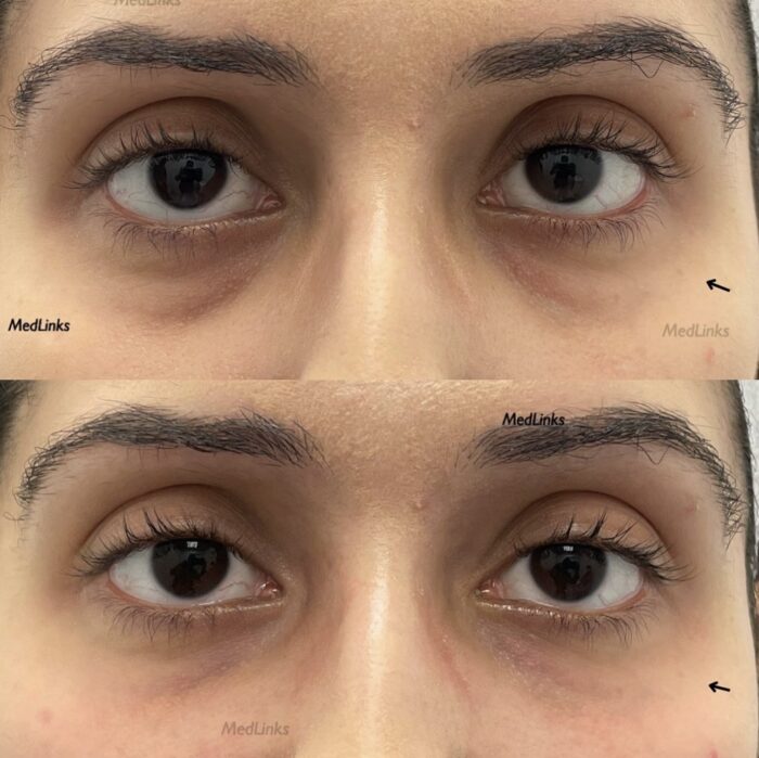 Under Eye Filler Treatment at MedLinks for Under Eye Rejuvenation