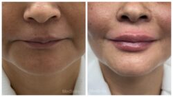 Enhance Your Look with Lip Filler Treatment at MedLinks