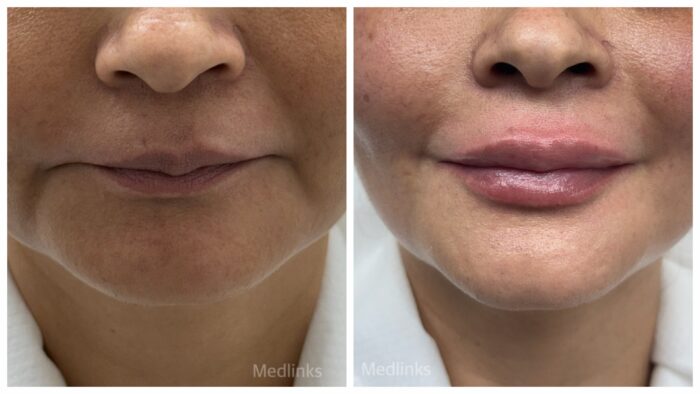 Enhance Your Look with Lip Filler Treatment at MedLinks