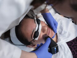 Morpheus8 Treatment for Acne Scars | MedLinks